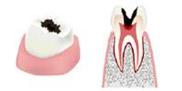 虫歯の大きさと治療方法