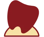 歯周病