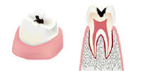 虫歯の大きさと治療方法