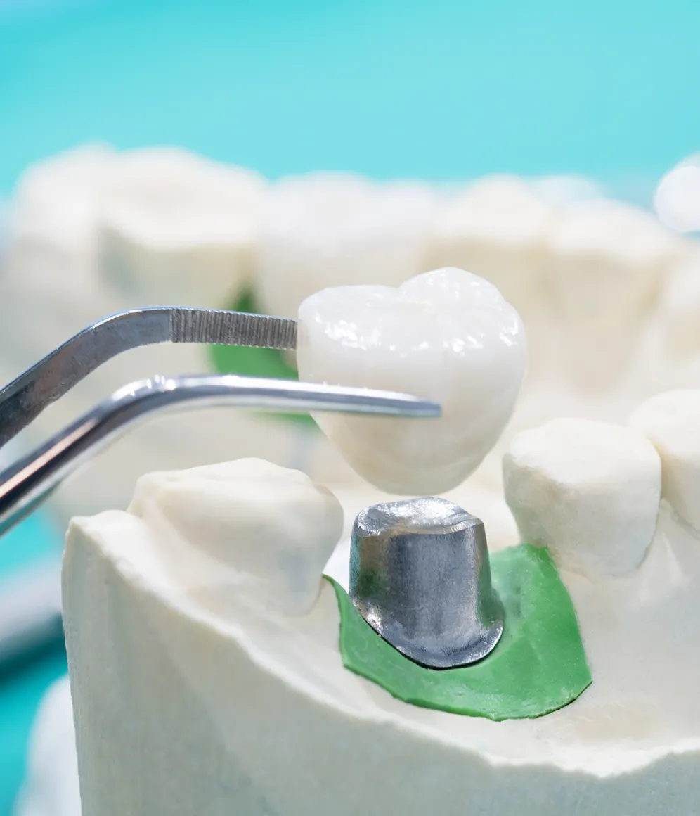 自分の歯と同じように噛めるインプラント