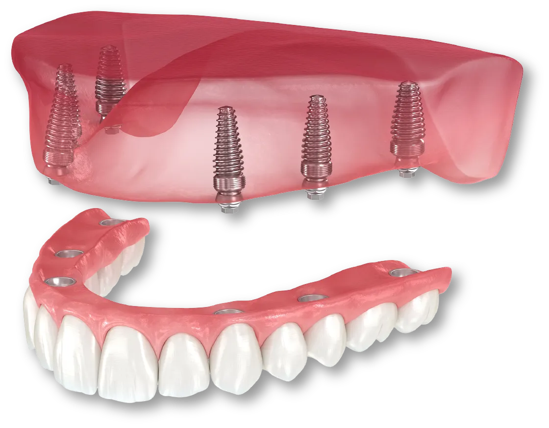 インプラントオーバーデンチャー